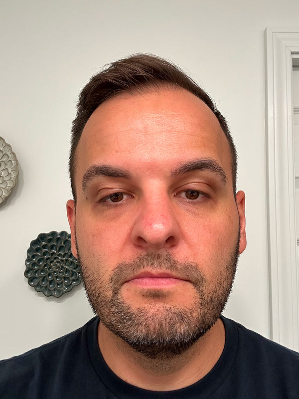 Customer before photo: front view of a man with short dark hair and stubble