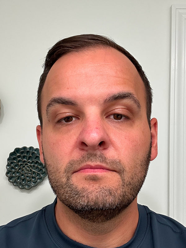 Customer after photo: front view of the same man with short dark hair and stubble