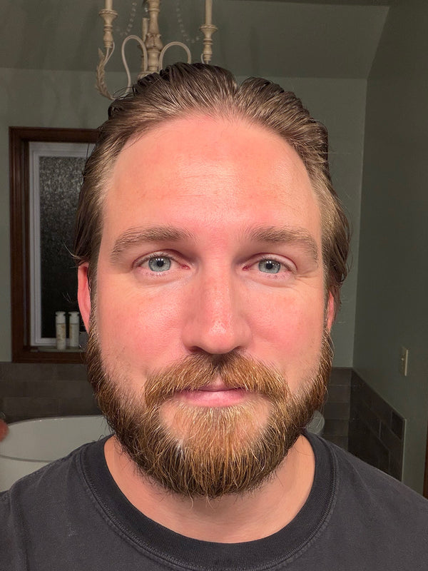 Customer after photo: front view of the same man with a full beard, hair combed back
