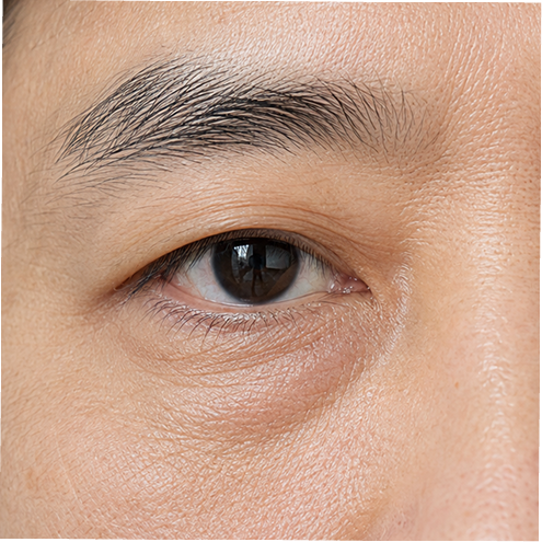 Close-up of a man's eye area showing under-eye bags and fine lines
